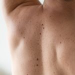 bacne back acne pimples wash