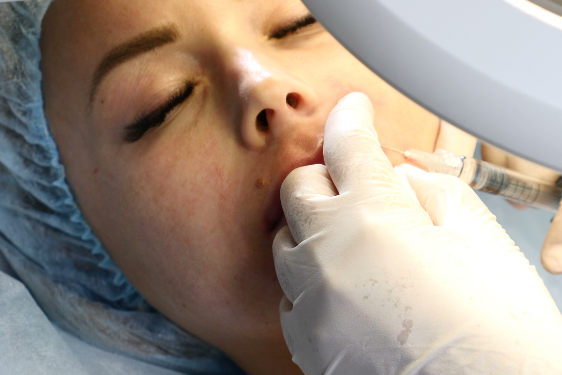 Hyaluronic acid lip filler being injected into the lips.