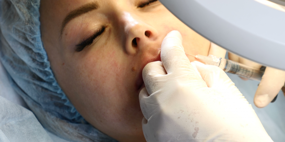 Hyaluronic acid lip filler being injected into the lips.