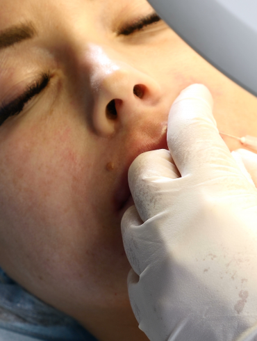 Hyaluronic acid lip filler being injected into the lips.