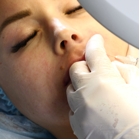Hyaluronic acid lip filler being injected into the lips.